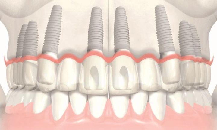 Maxillary Implant Guide: Understanding Procedures, Benefits, and Outcomes